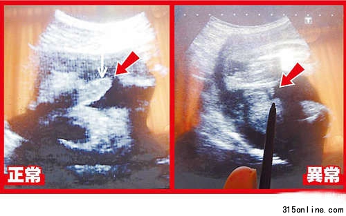 超聲波可看到胎兒生殖器,左圖箭頭處為28周正常男嬰生殖器:右圖箭頭處為異常男嬰28周時(shí)生殖器畫(huà)面。圖片來(lái)源:臺(tái)灣媒體 超聲波可看到胎兒生殖器,左圖箭頭處為28周正常男嬰生殖器:右圖箭頭處為異常男嬰28周時(shí)生殖器畫(huà)面。圖片來(lái)源:臺(tái)灣媒體